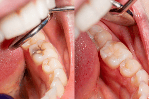 Fillings & Sealants