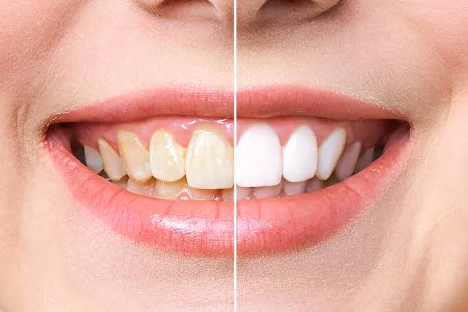 Teeth Whitening