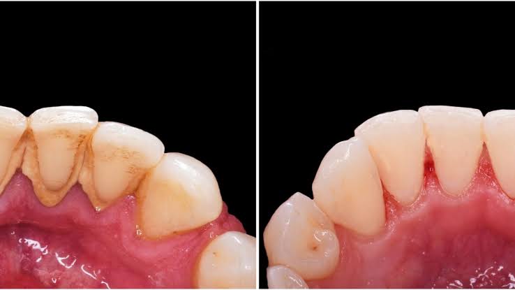 Teeth Cleaning