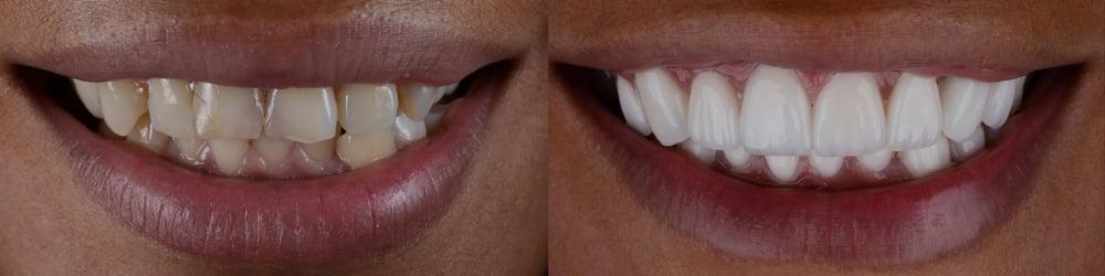 Veneers & Crowns