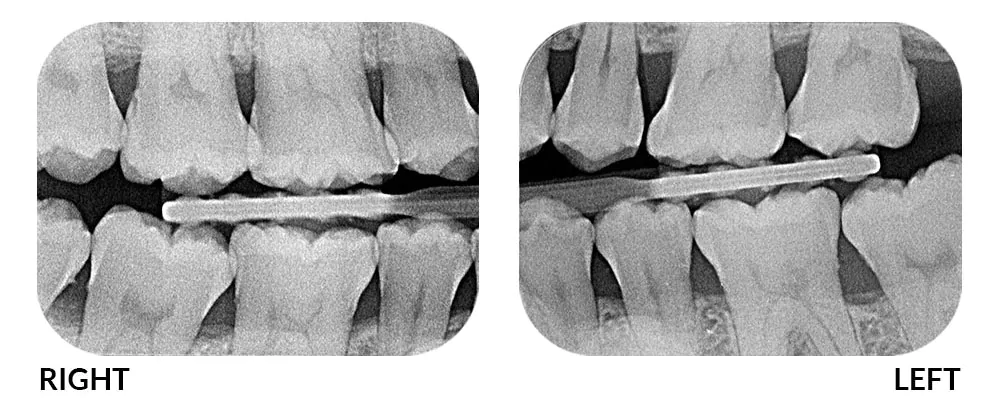 X-Ray
